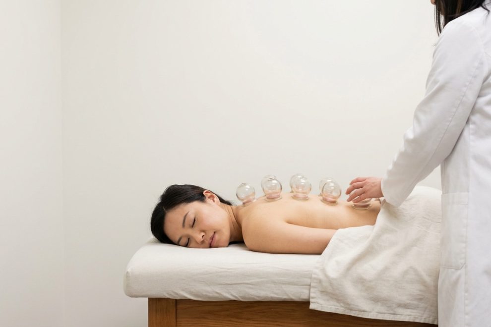 Cupping Therapy in Richmond BC