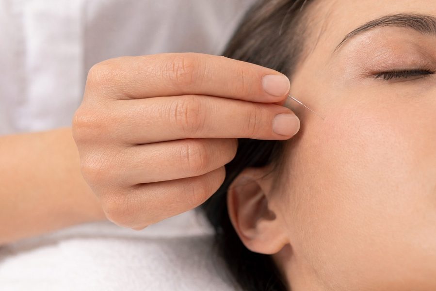 Facial (Cosmetic) Acupuncture in Richmond BC